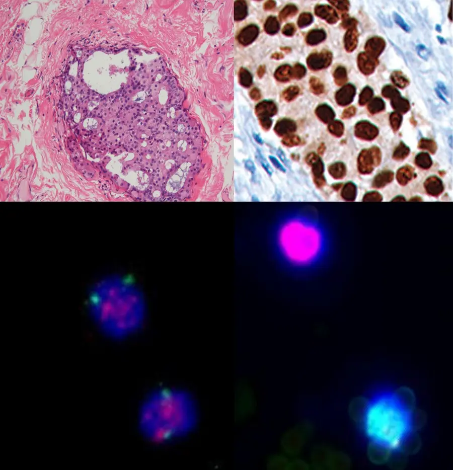 Évaluation anatomopathologique d'une biopsie mammaire